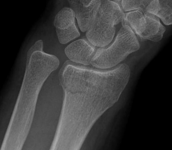 Distal radius volar ulnar fracture